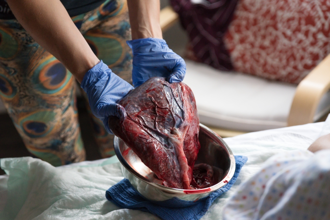 Midwife holding placenta in a bowl showing structures
